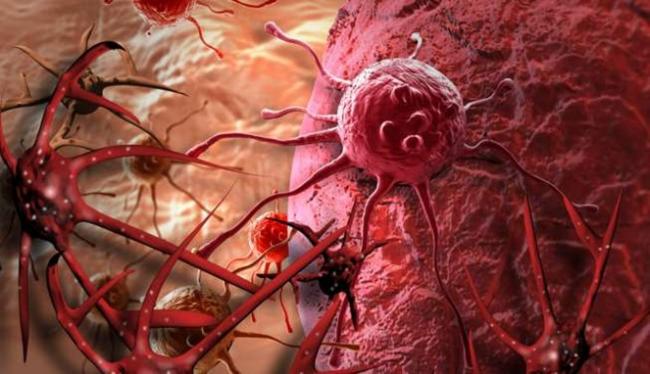 Tanpa Disadari 5 Kebiasaan Ini Dapat Memicu Kanker